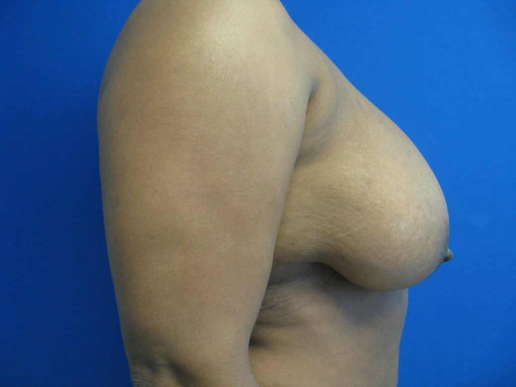 Breast Reduction Patient Plastic Surgeon In Chicago Christopoulos Plastic Surgery