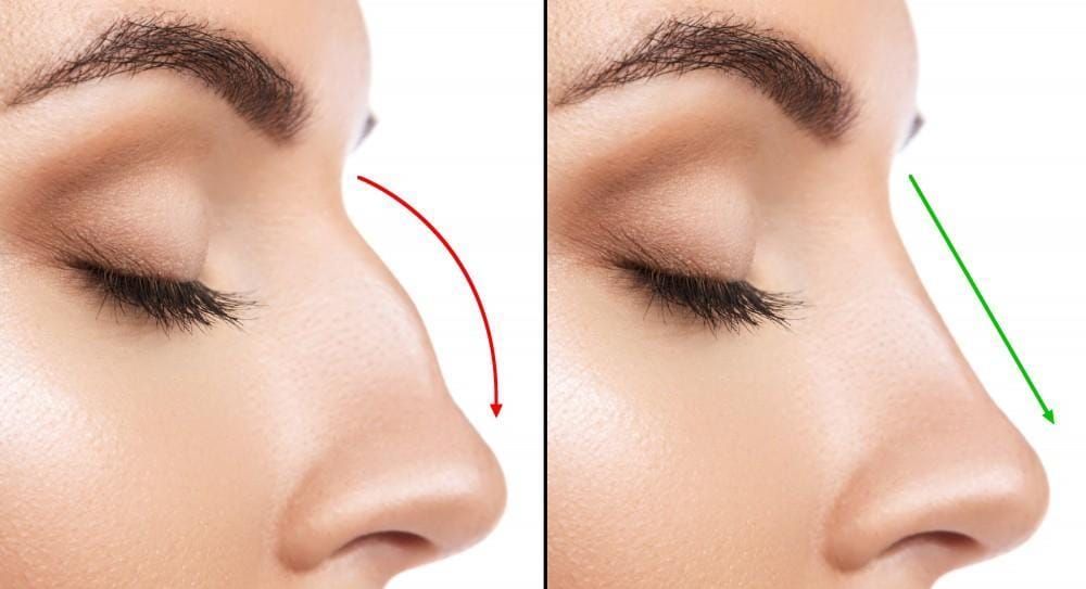 5 Myths About Rhinoplasty - Niki Christopoulos, MD FACS