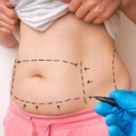 Liposuction Myths Debunked