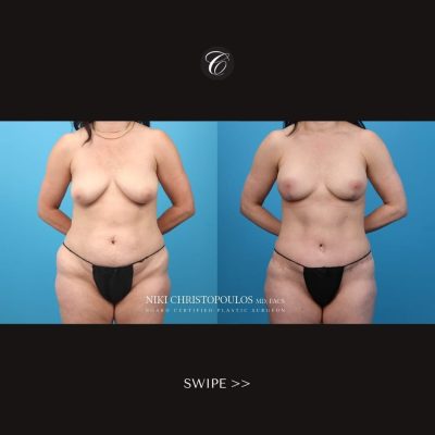 Niki Christopoulos Board Certified Plastic Surgeon (14)A