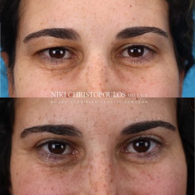 Niki Christopoulos Board Certified Plastic Surgeon (16)A